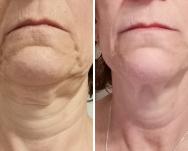 RD Cosmetic avant-après